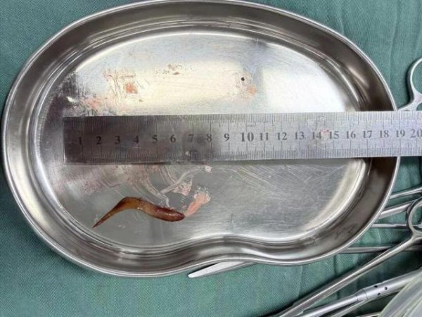 爱一配 男子甲鱼骨卡喉吞饭“自救”致腹腔感染 医生紧急提醒